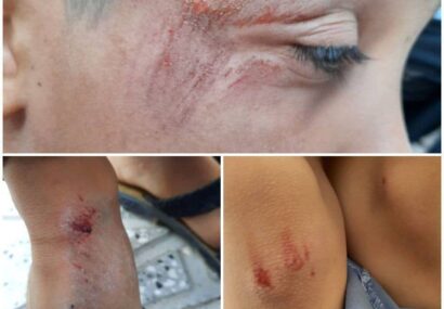 زخمی شدن دختربچه ۱۰ ساله باخرزی در پی حمله سگ‌های ولگرد/قابل‌توجه مسئولان عزیز در رشتخوار