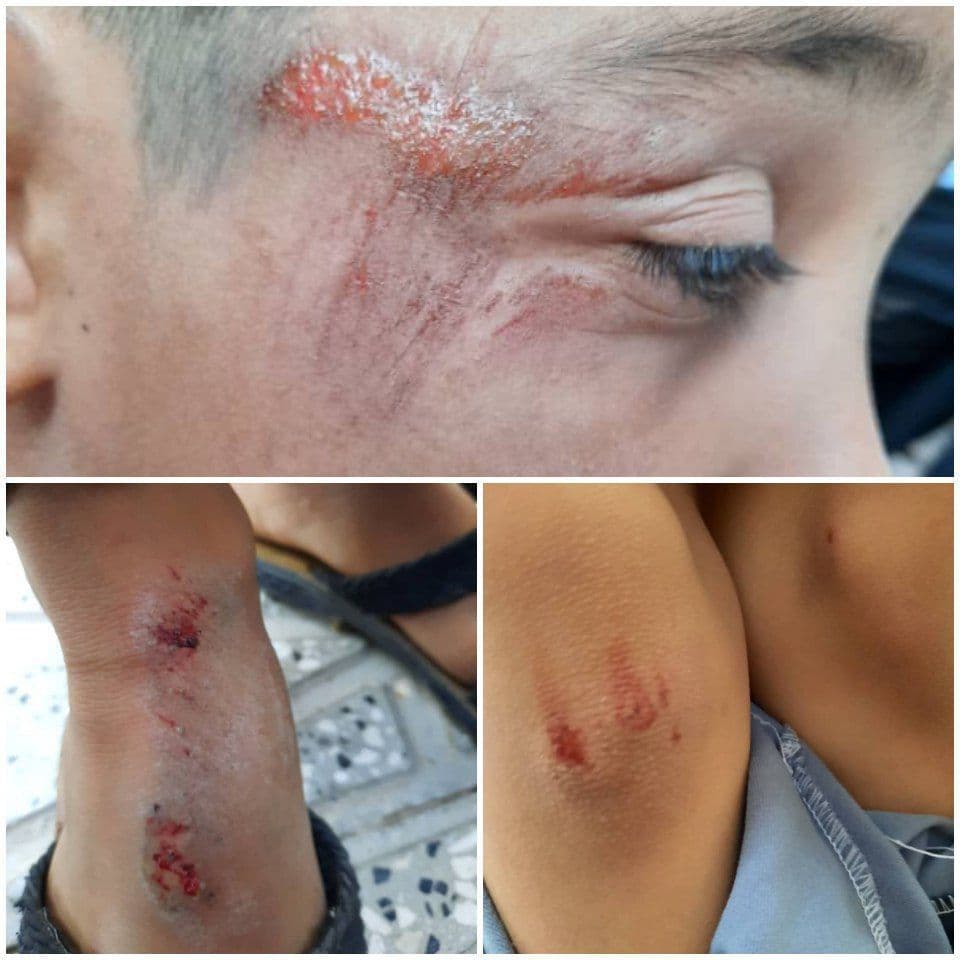 زخمی شدن دختربچه ۱۰ ساله باخرزی در پی حمله سگهای ولگرد/قابلتوجه مسئولان عزیز در رشتخوار